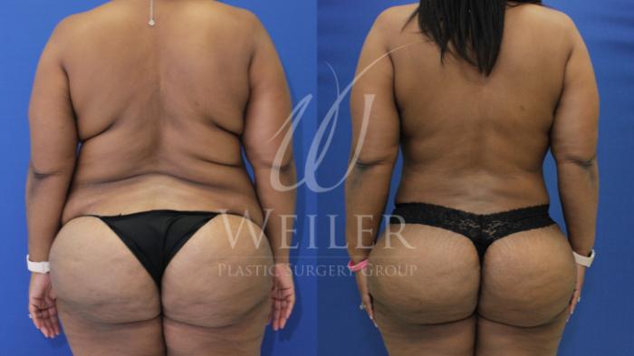 Before & After Tummy Tuck Case 838 Back View in Baton Rouge, Louisiana