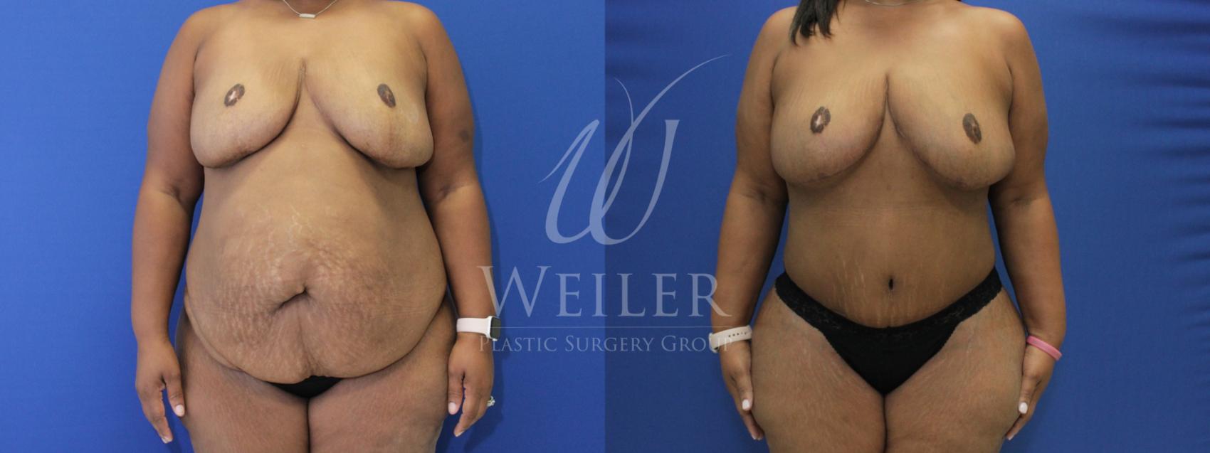 Before & After Tummy Tuck Case 838 Front View in Baton Rouge, Louisiana