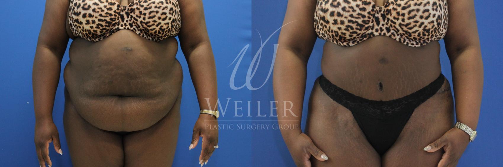 Before & After Tummy Tuck Case 839 Front View in Baton Rouge, New Orleans, & Lafayette, Louisiana