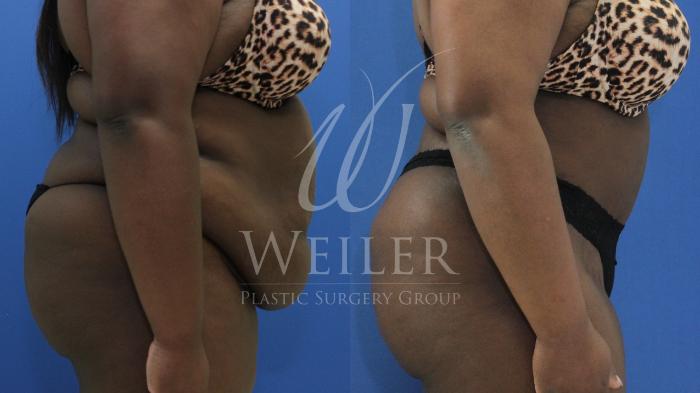 Before & After Tummy Tuck Case 839 Right Side View in Baton Rouge, New Orleans, & Lafayette, Louisiana