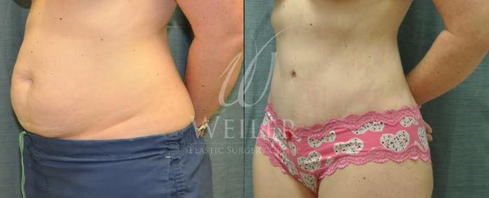 Before & After Tummy Tuck Case 84 View #1 View in Baton Rouge, New Orleans, & Lafayette, Louisiana