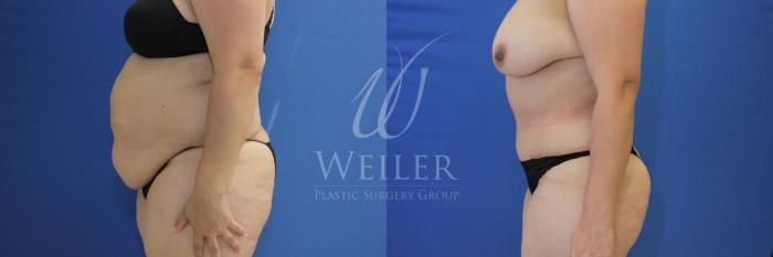 Before & After Tummy Tuck Case 840 Left Side View in Baton Rouge, Louisiana