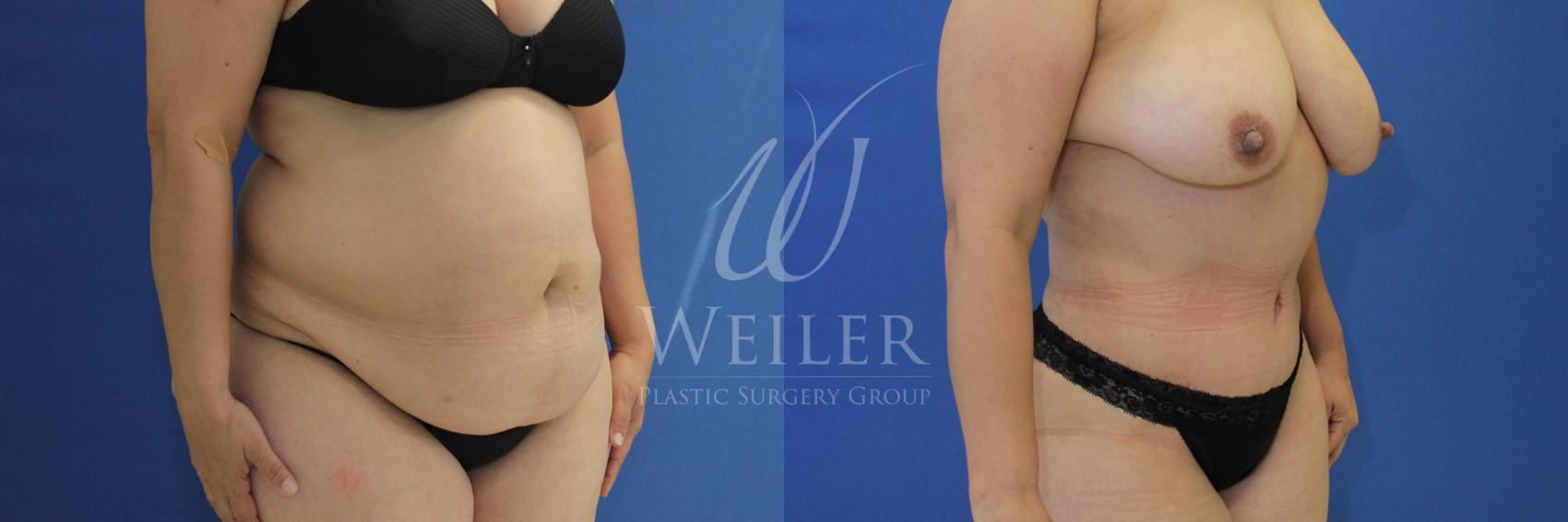 Before & After Tummy Tuck Case 840 Right Oblique View in Baton Rouge, Louisiana