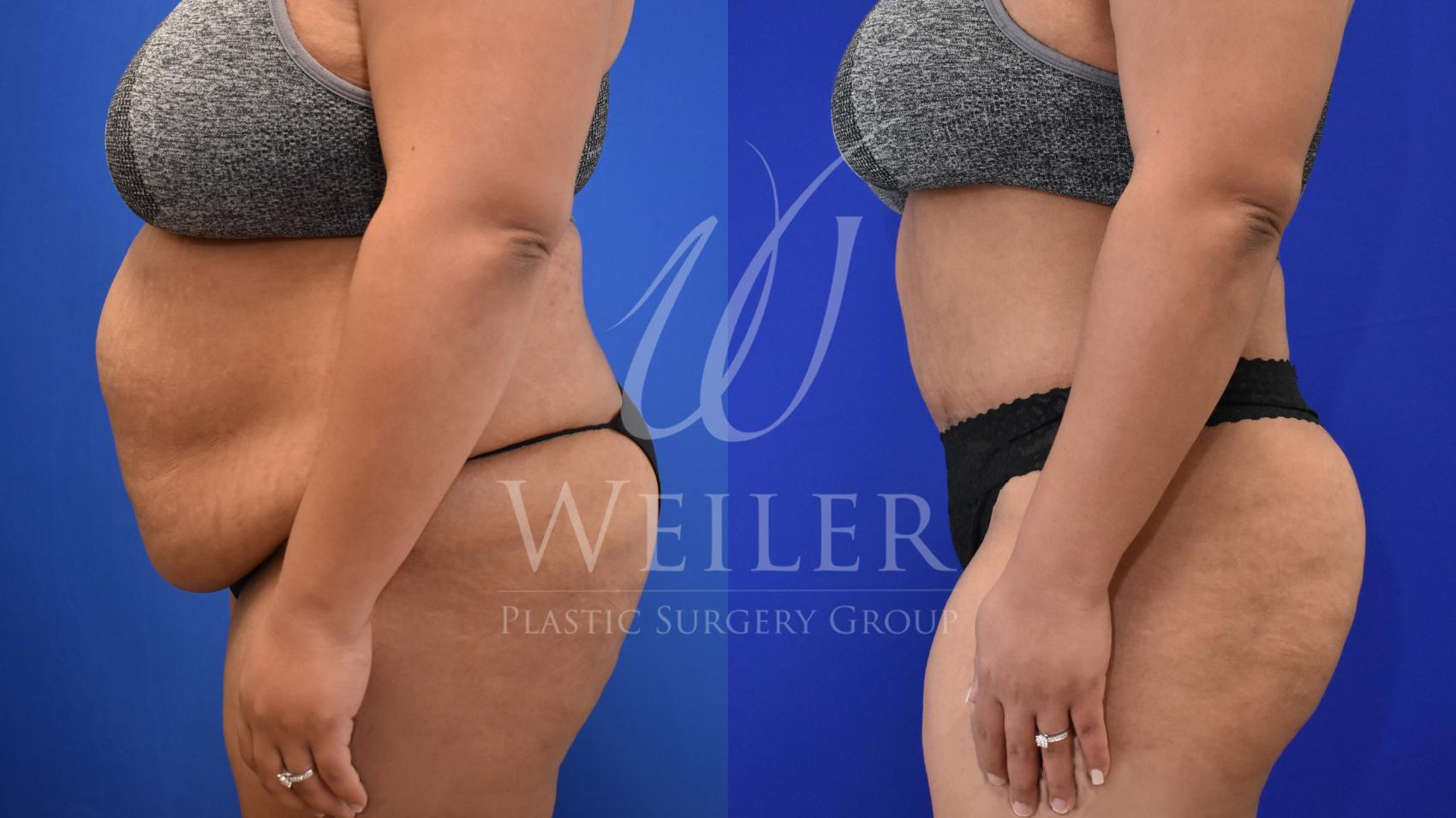 Before & After Tummy Tuck Case 841 Left Side View in Baton Rouge, Louisiana