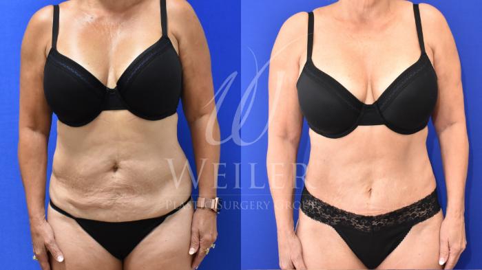 Before & After Tummy Tuck Case 846 Front View in Baton Rouge, New Orleans, & Lafayette, Louisiana