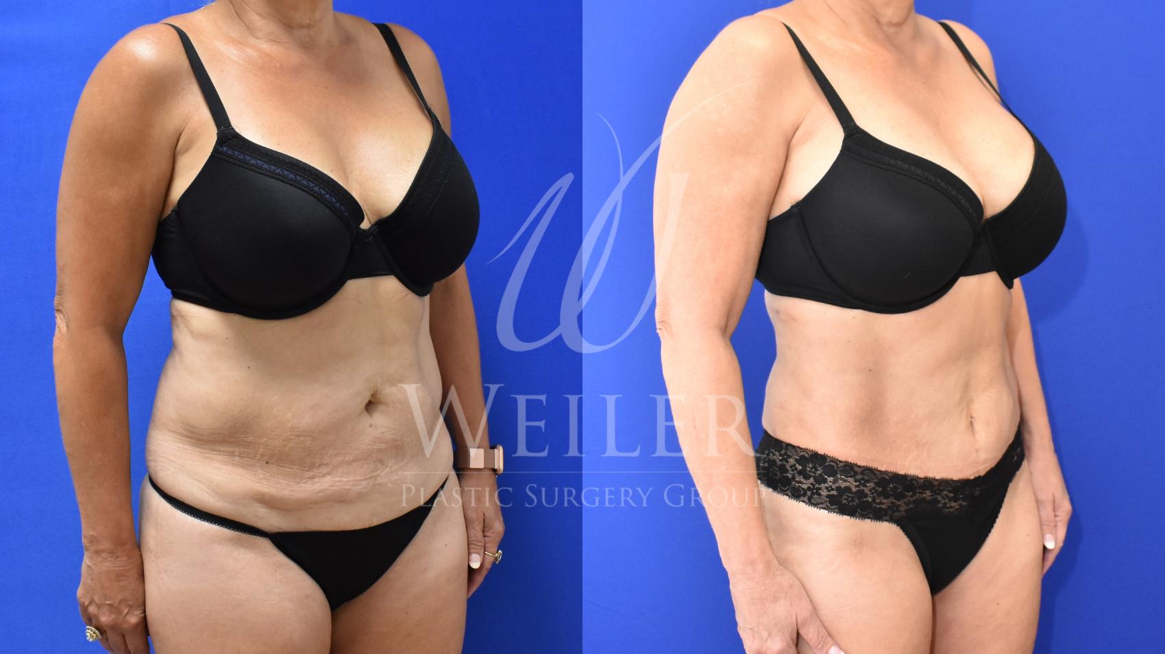 Before & After Tummy Tuck Case 846 Right Oblique View in Baton Rouge, New Orleans, & Lafayette, Louisiana