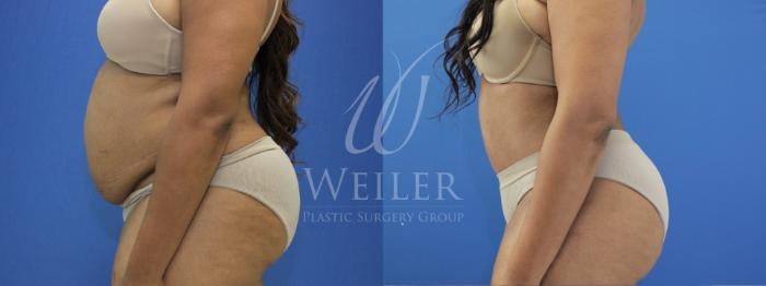 Before & After Tummy Tuck Case 847 Left Side View in Baton Rouge, New Orleans, & Lafayette, Louisiana