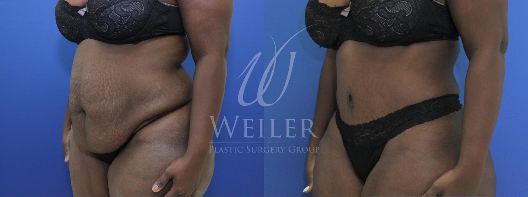Before & After Tummy Tuck Case 848 Left Oblique View in Baton Rouge, New Orleans, & Lafayette, Louisiana