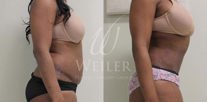 Before & After Tummy Tuck Case 85 View #2 View in Baton Rouge, New Orleans, & Lafayette, Louisiana