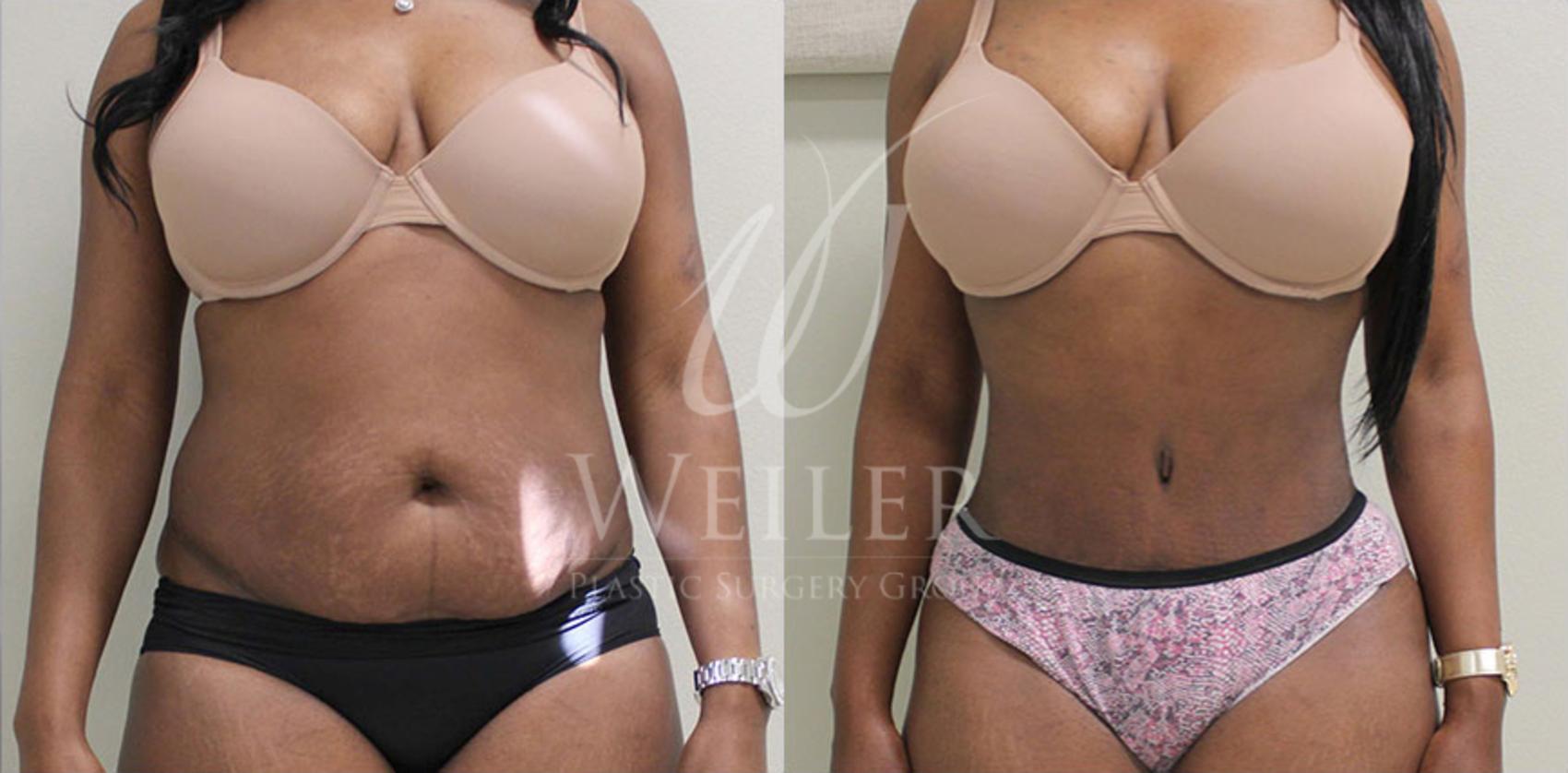 Before & After Tummy Tuck Case 85 View #3 View in Baton Rouge, New Orleans, & Lafayette, Louisiana
