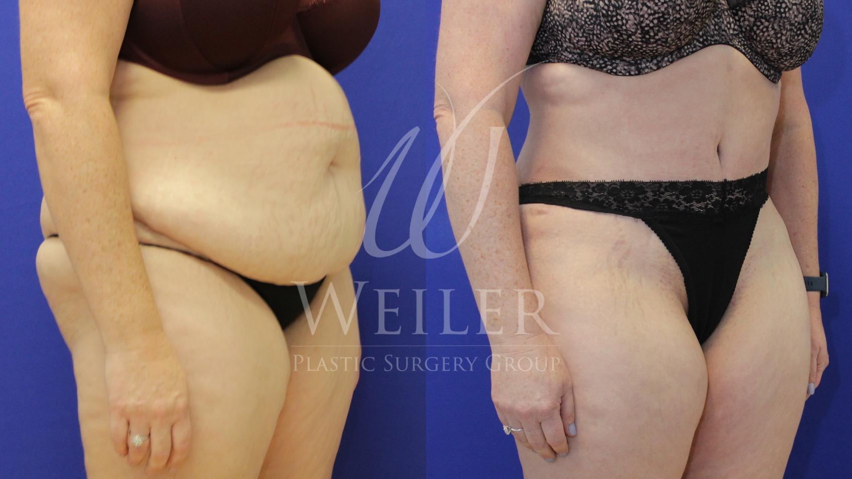 Before & After Tummy Tuck Case 851 Right Oblique View in Baton Rouge, New Orleans, & Lafayette, Louisiana