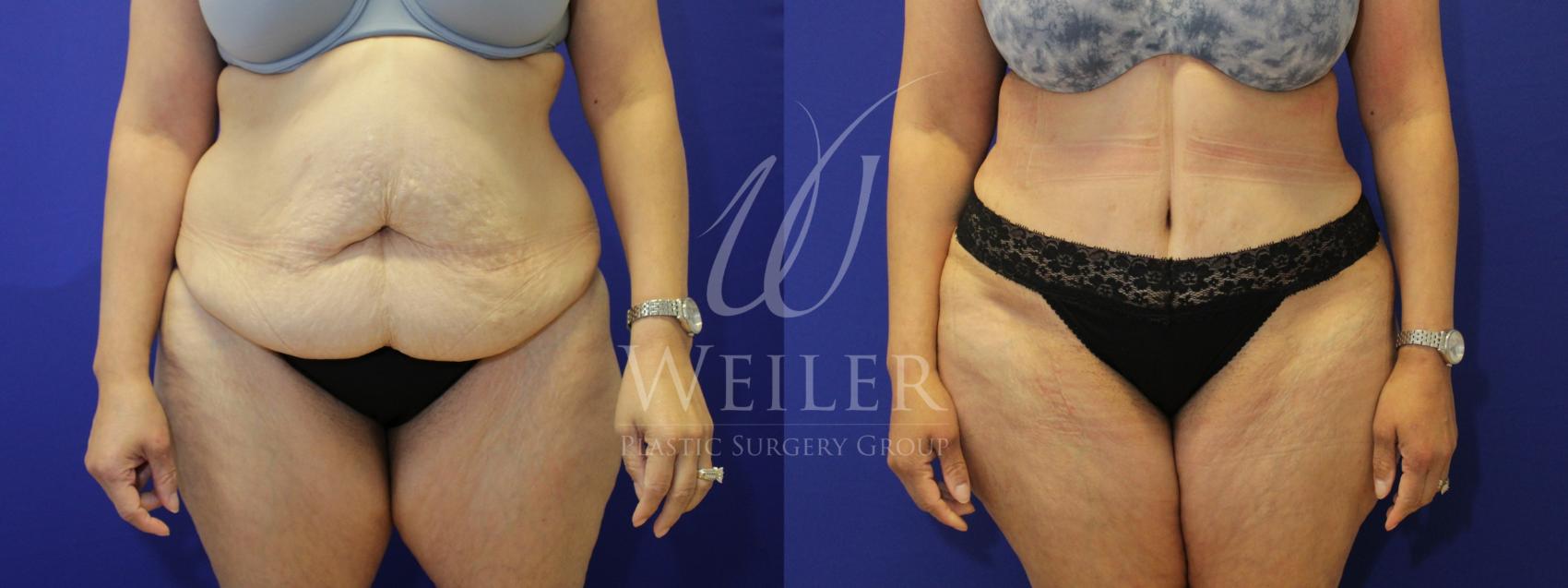 Before & After Tummy Tuck Case 853 Front View in Baton Rouge, New Orleans, & Lafayette, Louisiana