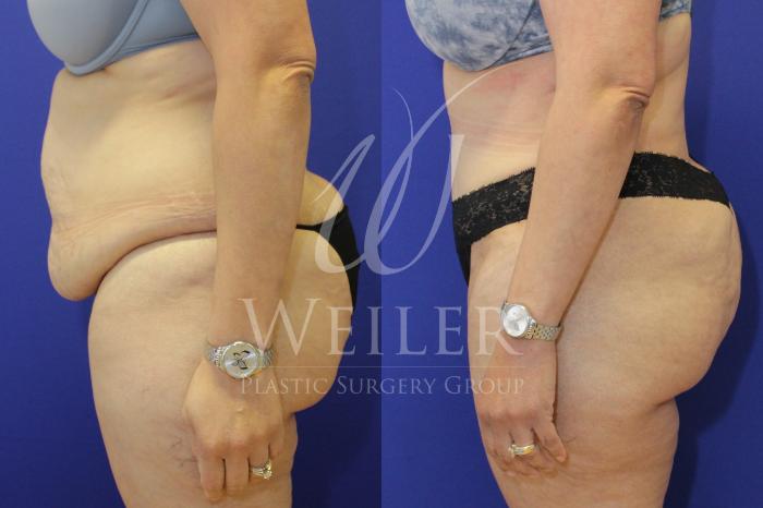 Before & After Tummy Tuck Case 853 Left Side View in Baton Rouge, New Orleans, & Lafayette, Louisiana
