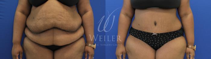 Before & After Tummy Tuck Case 865 Front View in Baton Rouge, New Orleans, & Lafayette, Louisiana