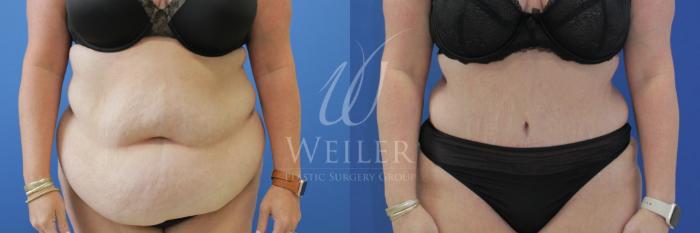Before & After Tummy Tuck Case 866 Front View in Baton Rouge, New Orleans, & Lafayette, Louisiana