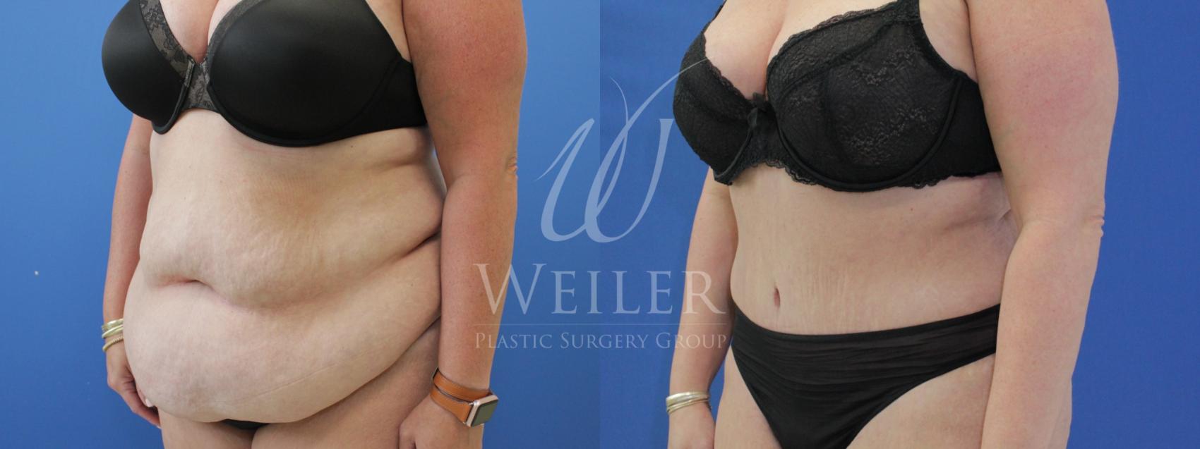Before & After Tummy Tuck Case 866 Left Oblique View in Baton Rouge, New Orleans, & Lafayette, Louisiana