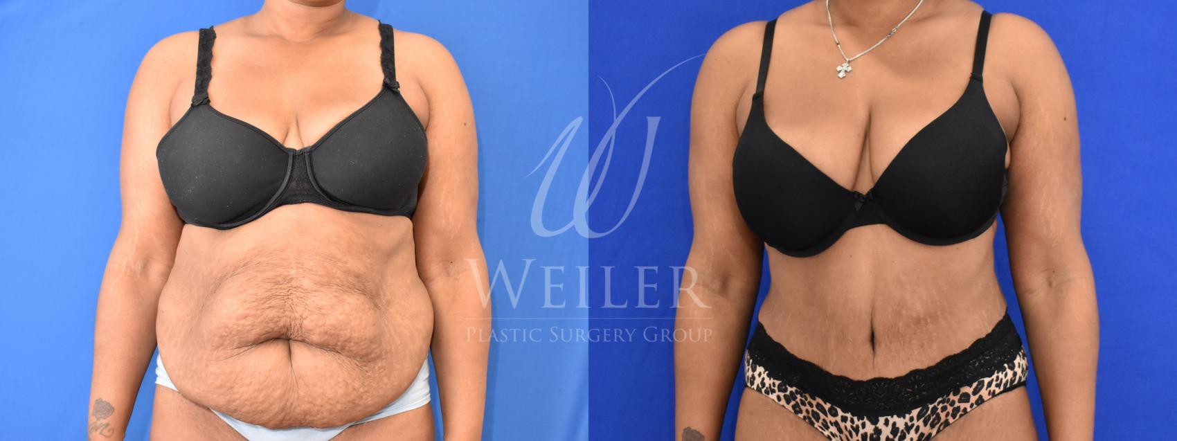 Before & After Tummy Tuck Case 867 Front View in Baton Rouge, New Orleans, & Lafayette, Louisiana