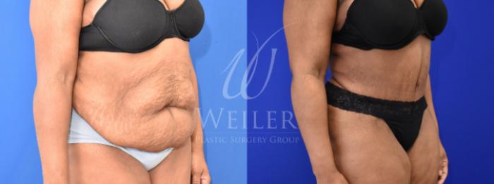 Tummy Tuck Before and After Pictures Case 867, Baton Rouge, Louisiana