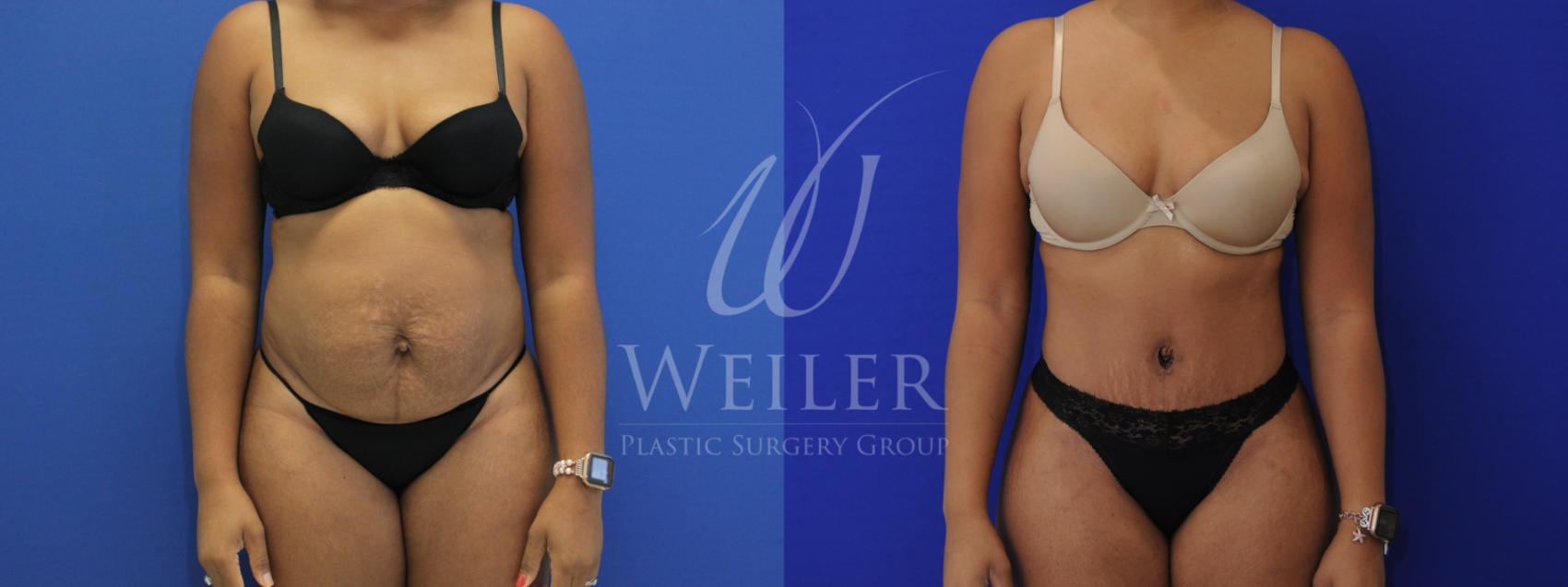 Before & After Tummy Tuck Case 873 Front View in Baton Rouge, New Orleans, & Lafayette, Louisiana