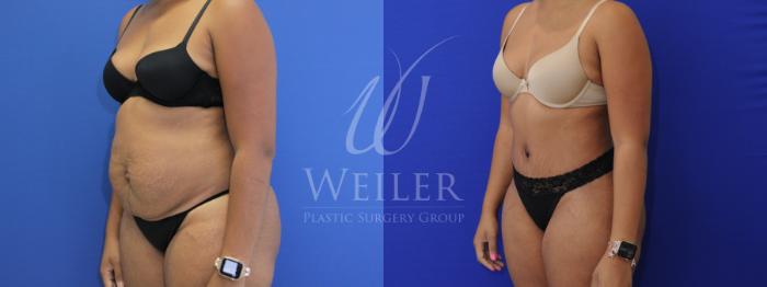Before & After Tummy Tuck Case 873 Left Oblique View in Baton Rouge, New Orleans, & Lafayette, Louisiana