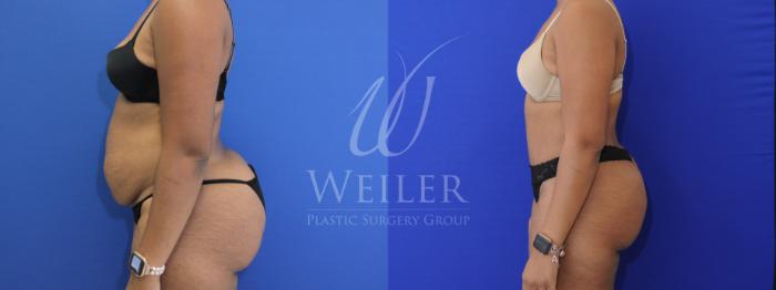 Before & After Tummy Tuck Case 873 Left Side View in Baton Rouge, New Orleans, & Lafayette, Louisiana
