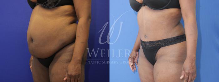 Before & After Tummy Tuck Case 875 Left Oblique View in Baton Rouge, New Orleans, & Lafayette, Louisiana
