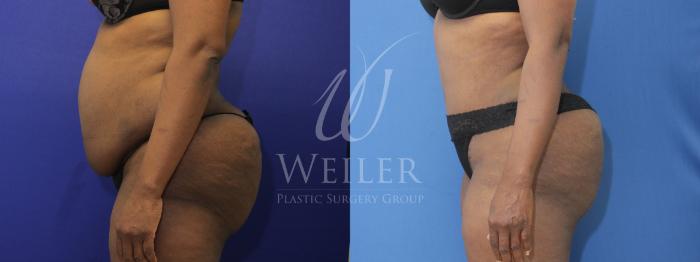 Before & After Tummy Tuck Case 875 Left Side View in Baton Rouge, New Orleans, & Lafayette, Louisiana