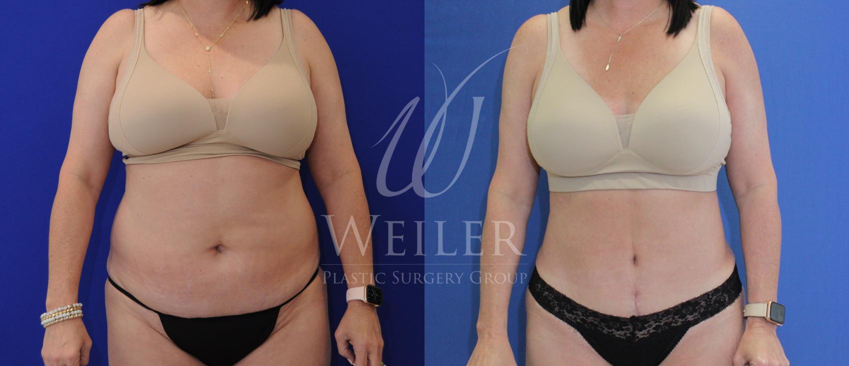 Before & After Tummy Tuck Case 876 Front View in Baton Rouge, Louisiana