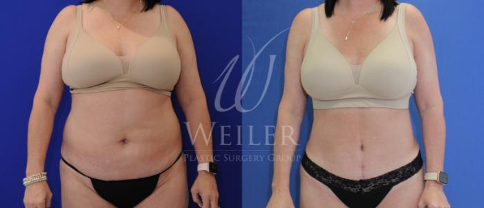 Breast Augmentation, Plastic Surgery, New Orleans - BRAS AFTER