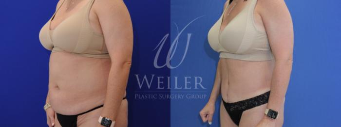 Before & After Tummy Tuck Case 876 Left Oblique View in Baton Rouge, Louisiana