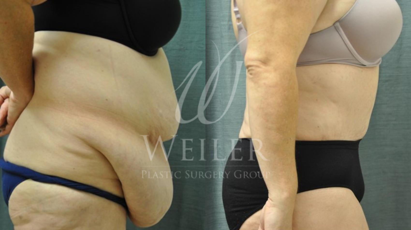 Before & After Tummy Tuck Case 88 View #1 View in Baton Rouge, Louisiana