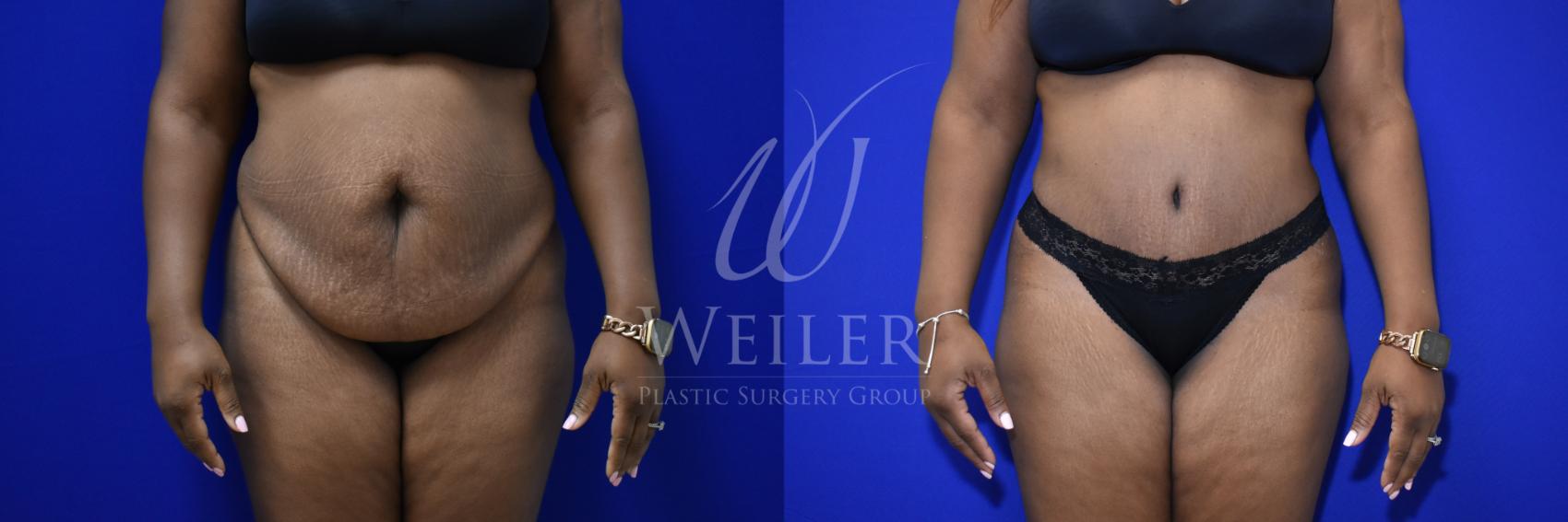 Before & After Tummy Tuck Case 880 Front View in Baton Rouge, Louisiana