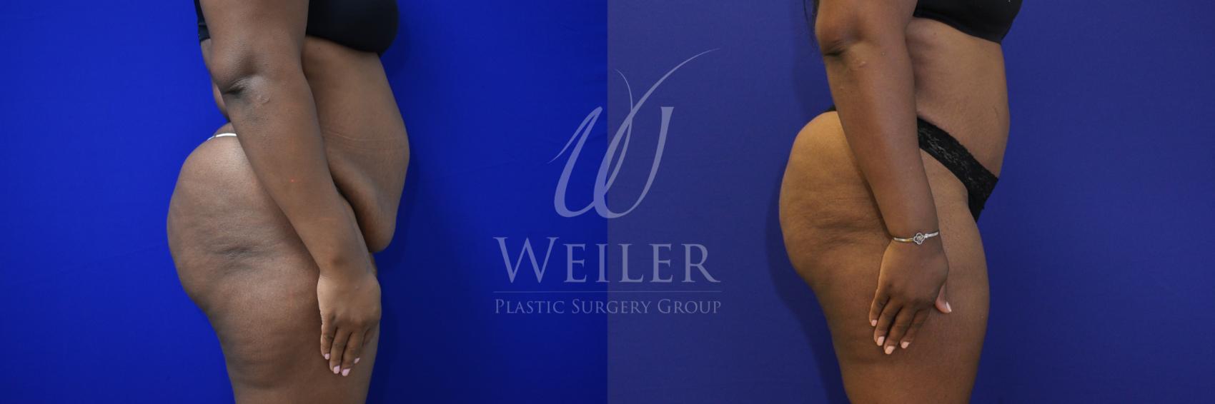 Before & After Tummy Tuck Case 880 Right Side View in Baton Rouge, Louisiana