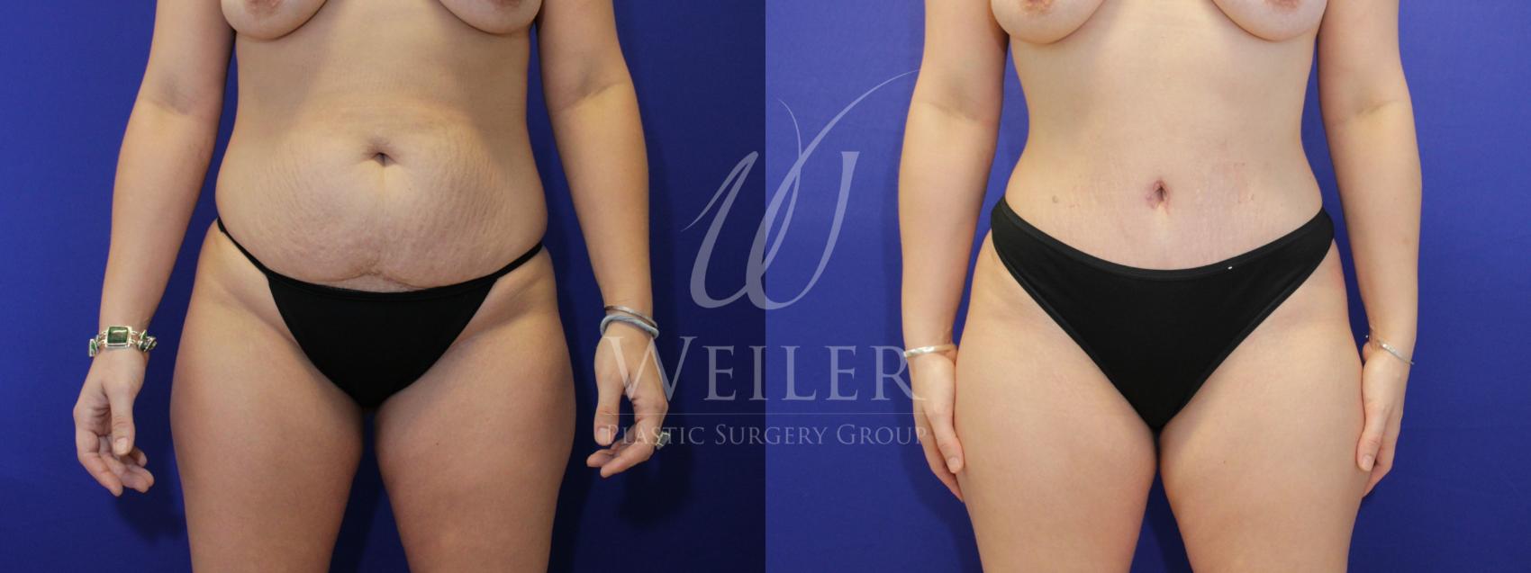 Before & After Tummy Tuck Case 883 Front View in Baton Rouge, New Orleans, & Lafayette, Louisiana