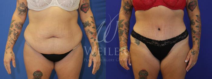 Before & After Tummy Tuck Case 885 Front View in Baton Rouge, New Orleans, & Lafayette, Louisiana