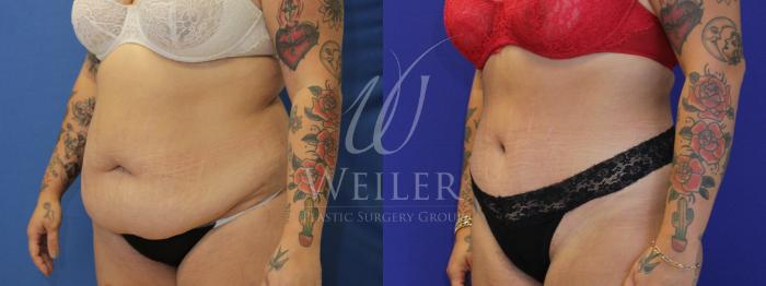 Before & After Tummy Tuck Case 885 Left Oblique View in Baton Rouge, New Orleans, & Lafayette, Louisiana