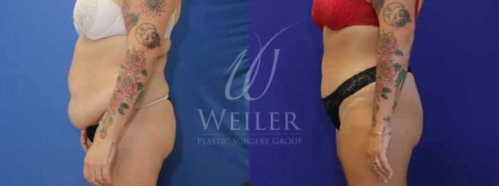 Before & After Tummy Tuck Case 885 Left Side View in Baton Rouge, New Orleans, & Lafayette, Louisiana