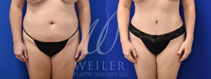 Before & After Tummy Tuck Case 886 Front View in Baton Rouge, New Orleans, & Lafayette, Louisiana