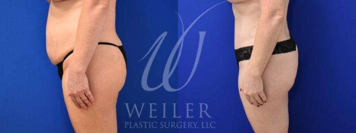 Before & After Tummy Tuck Case 886 Left Side View in Baton Rouge, New Orleans, & Lafayette, Louisiana