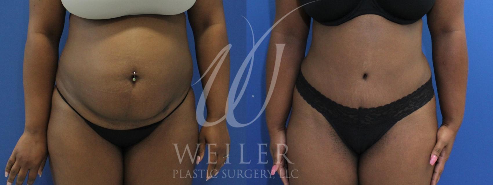 Before & After Tummy Tuck Case 892 Front View in Baton Rouge, New Orleans, & Lafayette, Louisiana