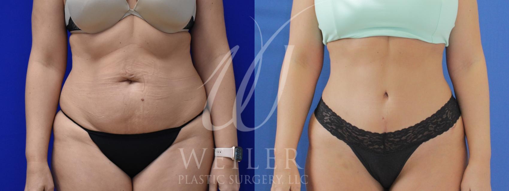 Before & After Tummy Tuck Case 899 Front View in Baton Rouge, Louisiana