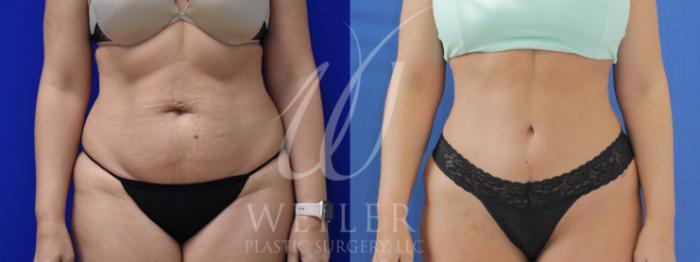 Before & After Tummy Tuck Case 899 Front View in Baton Rouge, New Orleans, & Lafayette, Louisiana