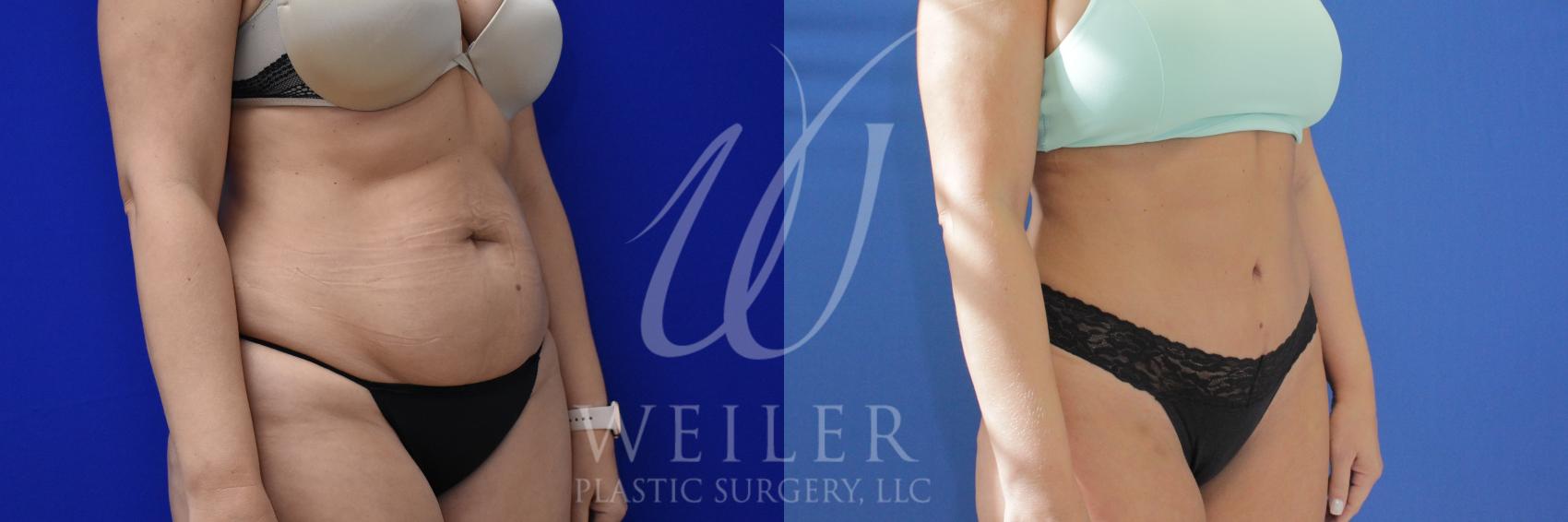 Tummy Tuck Before And After Pictures Case Baton Rouge New Orleans Lafayette Louisiana