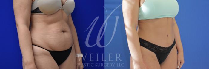 Before & After Tummy Tuck Case 899 Right Side View in Baton Rouge, New Orleans, & Lafayette, Louisiana
