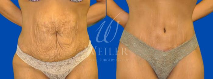 Before & After Tummy Tuck Case 90 View #1 View in Baton Rouge, New Orleans, & Lafayette, Louisiana