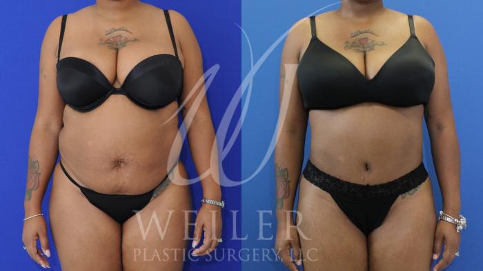 Before & After Tummy Tuck Case 907 Front View in Baton Rouge, New Orleans, & Lafayette, Louisiana