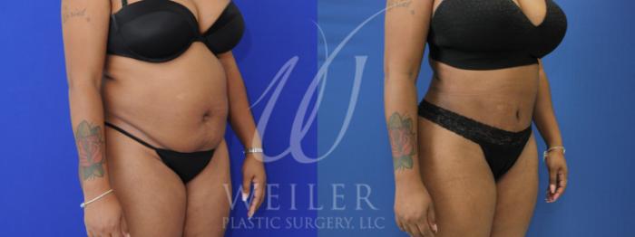Before & After Tummy Tuck Case 907 Right Oblique View in Baton Rouge, New Orleans, & Lafayette, Louisiana