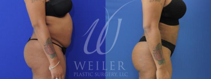 Before & After Tummy Tuck Case 907 Right Side View in Baton Rouge, New Orleans, & Lafayette, Louisiana