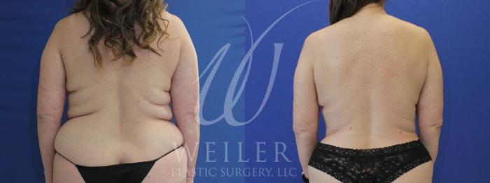 Before & After Tummy Tuck Case 916 Back View in Baton Rouge, New Orleans, & Lafayette, Louisiana