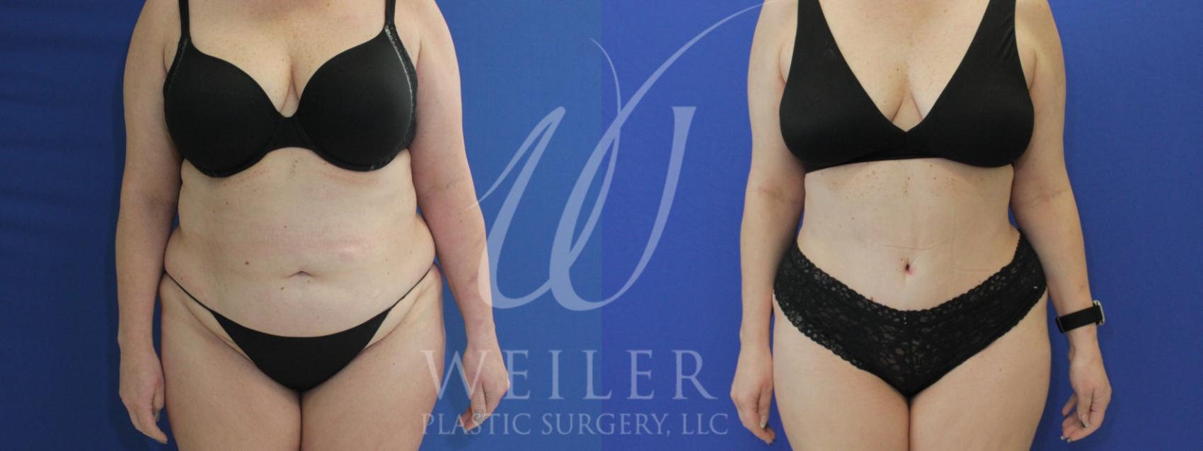 Before & After Tummy Tuck Case 916 Front View in Baton Rouge, New Orleans, & Lafayette, Louisiana